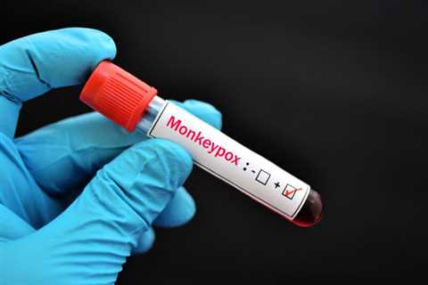 NV health officials warn everyone is vulnerable to monkeypox