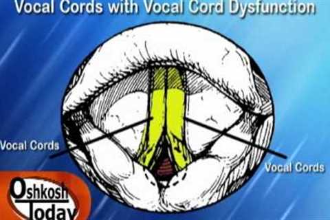 Vocal Cord Dysfunction