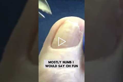 Thick Toenails and a Callus  #foothealth #drnailnipper #nsaleonyoutube #thicktoenail #callus