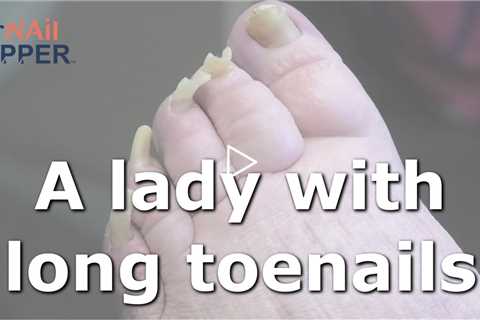 A lady with long toenails. FEET-ure  👩🏻‍⚕️🦶👣🦵🚶🏃