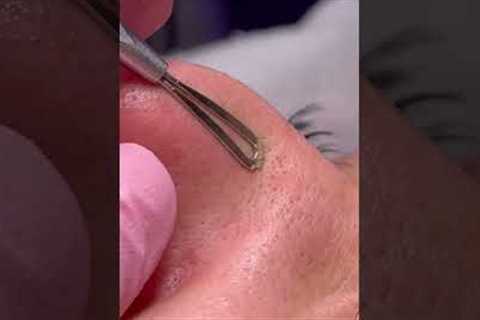 Esthetician Close-Up Satisfying Skin Cleaning