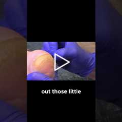 Managing Thick Calluses No Cure! #CallusManagement #healthtips  #skincare