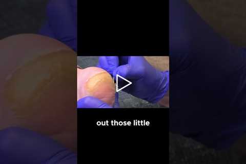 Managing Thick Calluses No Cure! #CallusManagement #healthtips  #skincare