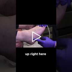 Identifying Athlete's Foot Infection #AthletesFoot #FootHealth #poolsafety