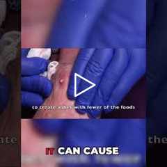 Medication Impact Hydrochlorothiazide and Gout