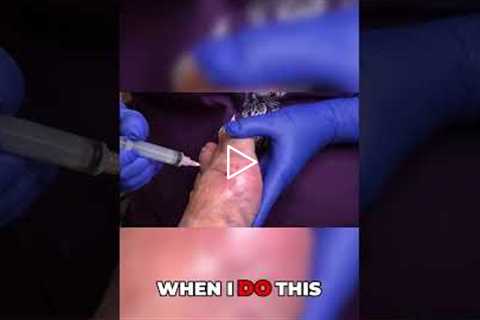 Understanding Gout Symptoms and Causes