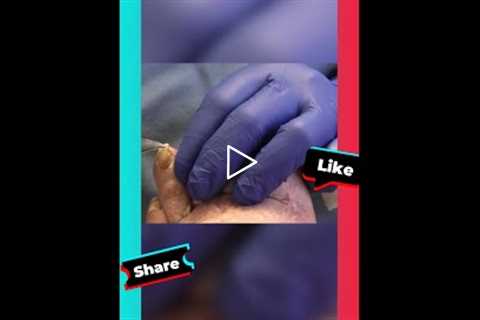 Diabetes and Nail Care Importance