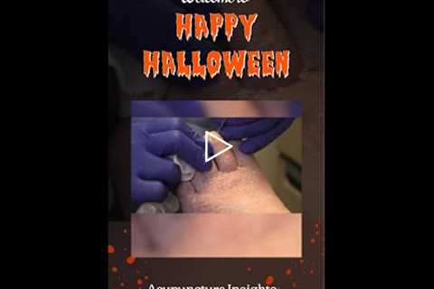 Acupuncture Insights