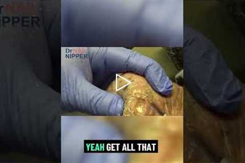 Whose Feet Are These? 😲 Immediate Relief for Throbbing Calluses