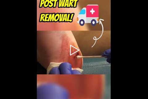 Aftercare Tips Post Wart Removal! 🚑