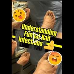 Why This Nail Problem Keeps Coming Back | Understanding Fungal Nail Infections 🦶