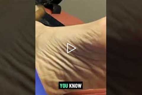 Exploring Callus Management Techniques | Callus Plugs: Why They Hurt So Much! 🦶😖