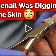 This Toenail Was Digging Into the Skin 😳 | Painful Foot Relief