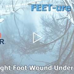 FEET-ure Friday | He Thought It Was a Blood Blister… What We Found Under This Callus Will Shock You