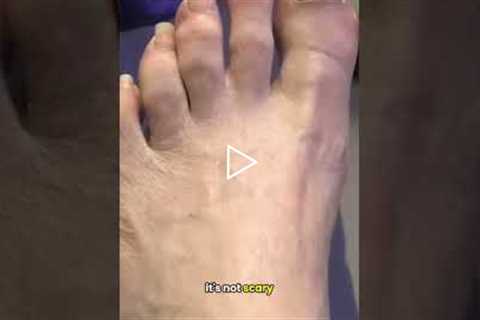 Instant Relief After a Long-Overdue Pedicure 👣 This Tool Has More Power! 😄Nail Trim - Dr Nail..