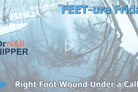 FEET-ure Friday | He Thought It Was a Blood Blister… What We Found Under This Callus Will Shock You