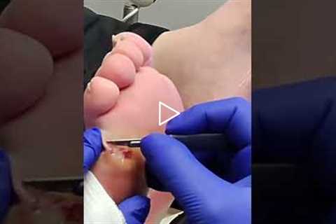 Understanding the Cause of a Foot Wound 👣