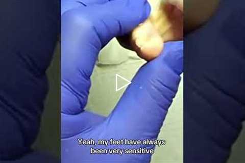 Why You Can't Trim Your Own Toenails