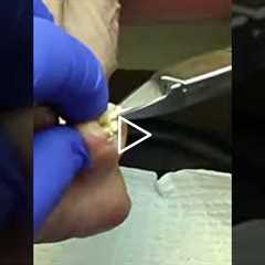 Why Your Toenails Keep Pinching Your Skin (Curved Nail Explained)