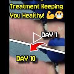The Journey of Wart Treatment Keeping You Healthy! 💪😷