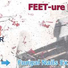 ✨ FEET-ure Friday - Fungal Nails Explained: Real Patient, Real Answers, Real Care 🦶🍄