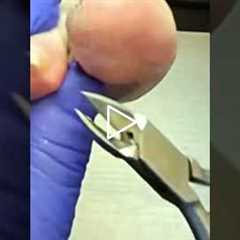 The Most Satisfying Part of a Podiatrist Visit 👣✨