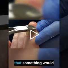 Nail Injuries What You Need to Know!