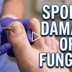 Long 2nd Toes and Thick Nails: Sports Damage or Fungus? 👣