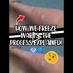 How We Freeze Warts The Process Explained! 🥶🔍