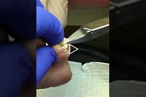 Why Your Toenails Keep Pinching Your Skin (Curved Nail Explained)