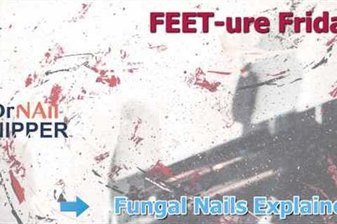 ✨ FEET-ure Friday - Fungal Nails Explained: Real Patient, Real Answers, Real Care 🦶🍄