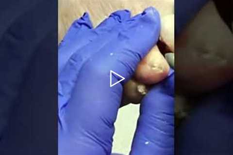 ✨ The Final Step: Polishing a Podiatrist’s Work 👣🩺