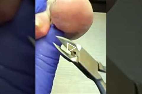 The Most Satisfying Part of a Podiatrist Visit 👣✨