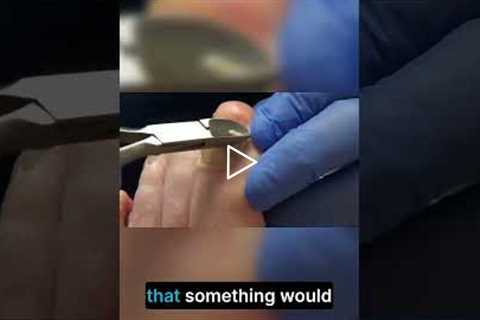 Nail Injuries What You Need to Know!