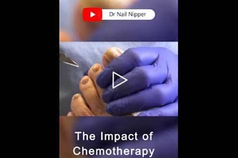 The Impact of Chemotherapy on Immunity