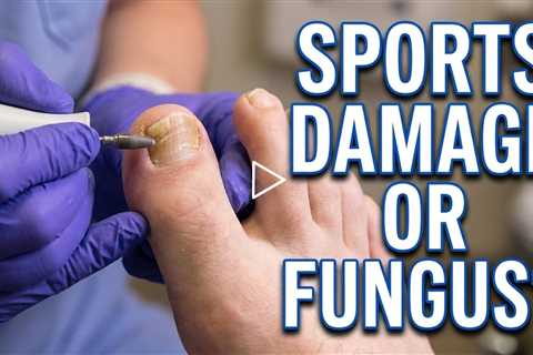 Long 2nd Toes and Thick Nails: Sports Damage or Fungus? 👣