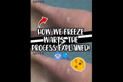 How We Freeze Warts The Process Explained! 🥶🔍