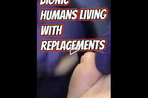 Bionic Patients & Neuropathy Talk: What to Watch For