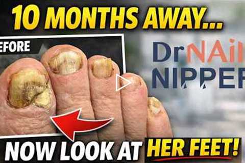 FEET-ure Friday | She Stayed Away 10 Months… These Toenails Tell the Story