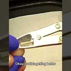 Why Broken Bones Heal Slower As We Age 🦴 (Real Patient Story)