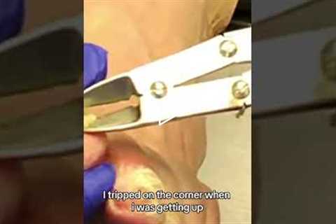 Tripped and flew into a dining room table