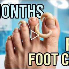 FEET-ure Friday |  Her Toenails Curled UNDER Her Toes After 7 Months 😳🦶