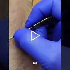 This podiatrist removes calluses while talking about boring summers #satisfying #podiatrist