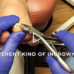 FEET-ure Friday | A Different Kind of Ingrown Nail