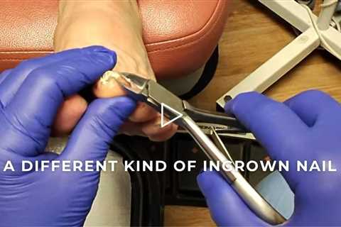 FEET-ure Friday | A Different Kind of Ingrown Nail
