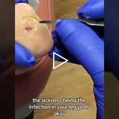 This Wound Is So Close to Being Healed! 🙌