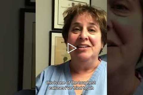 What Happens When You Don't Treat Your Callus #footpain #podiatry #callusremoval